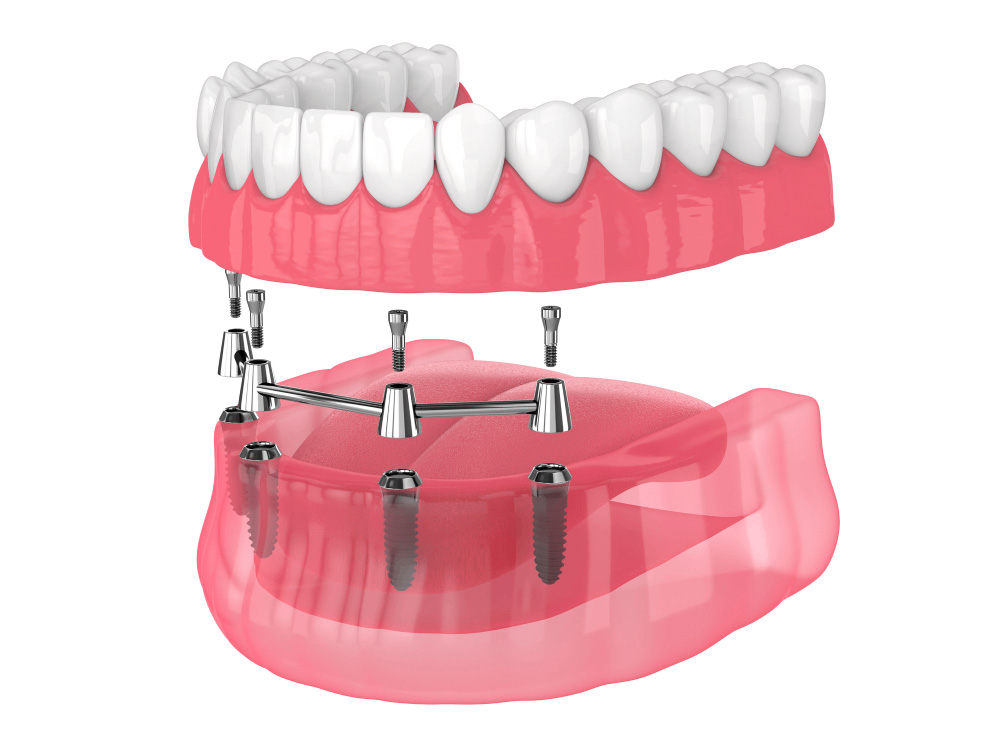 Full-Mouth Dental Implants