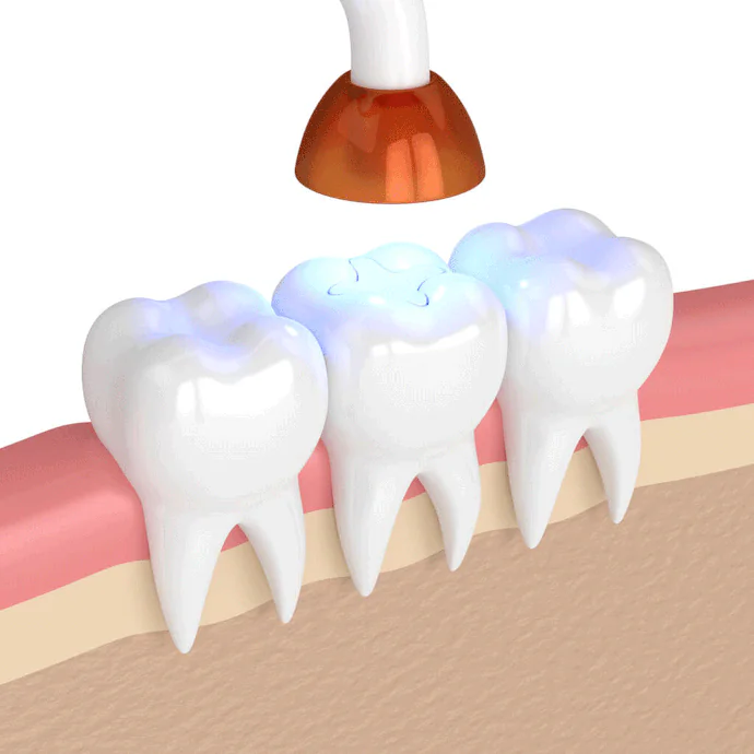 Tooth Fillings in Horseshoe Bay, TX at Horseshoe Bay Dental